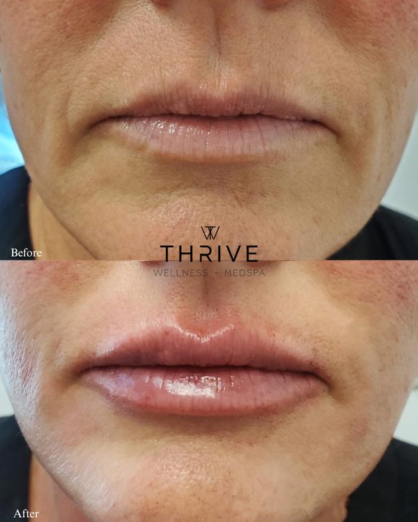 Botox before and after at Thrive Wellness