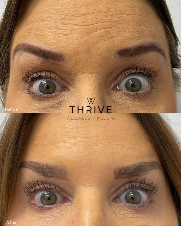 Botox before and after at Thrive Wellness