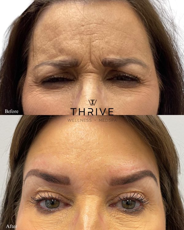 Botox before and after at Thrive Wellness